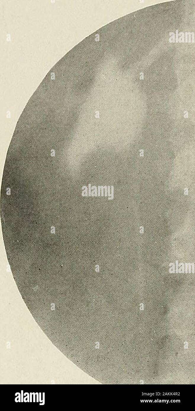 Pyelography (pyelo-ureterography) a study of the normal and pathologic ...