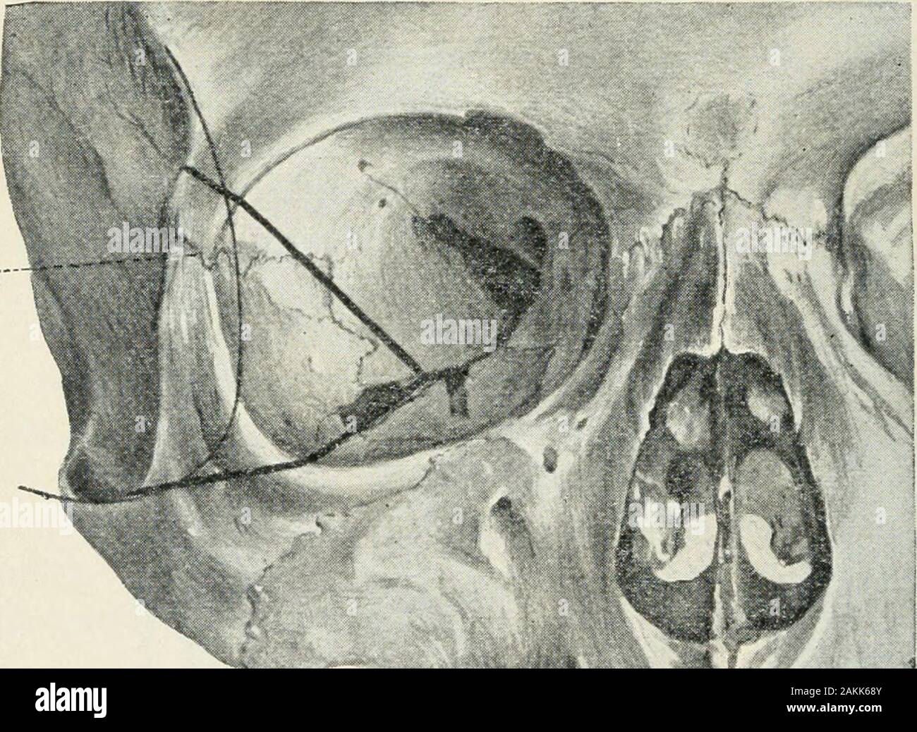 Atlas and epitome of operative ophthalmology . 285 286 OPERATIONS ON THE EYE. Plate io. Opening of the orbit after Krönlein. The skin-muscle-bone flap hasbeen reflected forward and shows a large portion of the periorbita. Thelatter is then incised from behind forward, producing the picture shownon the next Plate. as for Fig. 117), are illustrated in Figs. 106-116. Axen-feld lias devised for this operation special blunt hooks andholders or retractors, in the form of round plates attachedto an angulated handle, for holding the orbital tissuesapart. (This may be obtained from Windier, in Berlin.) Stock Photo
