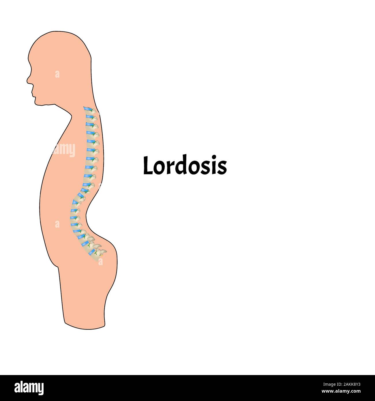 lumbar lordosis person