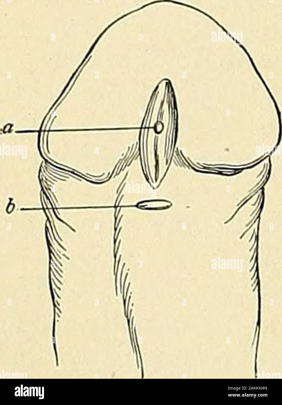 Hypospadias High Resolution Stock Photography And Images Alamy Hypospadias High Resolution Stock Photography And Images Alamy