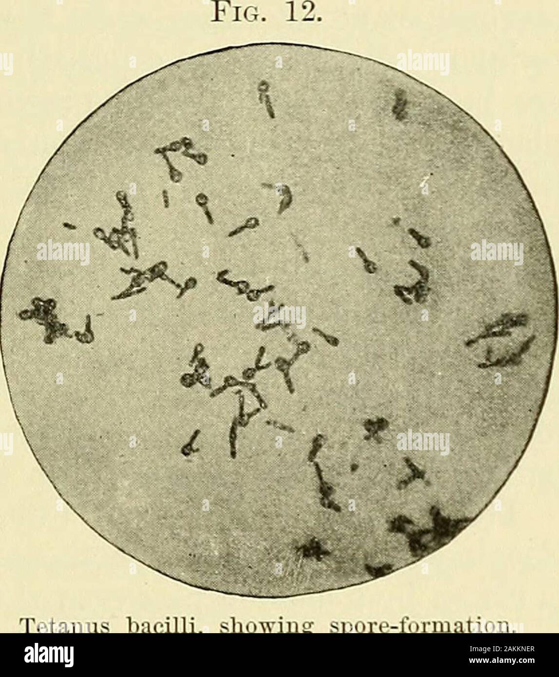 A manual of modern surgery : an exposition of the accepted doctrines and approved operative procedures of the present time, for the use of students and practitioners . times is explained byits bacterial causation. Tetanus of the newborn child is due to infec-tion of the stump of the umbilical cord. The bacillus of tetanus is an anaerobe, that is, grows without oxy-gen ; and has spores developed at one end. In the spore-forming stagethe micro-organism resembles a tack or nail. Symptoms.—The time of appearance of tetanus is usually from fiveto ten days after the receipt of the injury ; though th Stock Photo