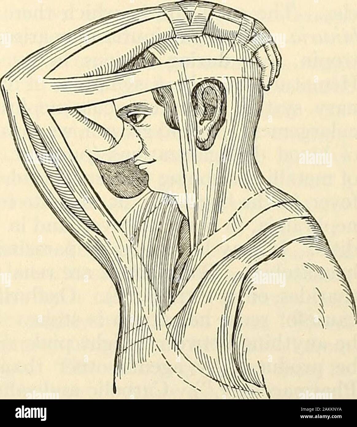photo Italian Nose Rhinoplasty https www alamy com modern surgery general and operative fig 845indian method of rhinoplasty fig 846italian method of rhinoplasty in the septum below the tip are both objectionable the first leaves an im sightly scar and does not allow for stretching of the skin the incision at thetip gives imsatisfactory access to the tissues requiring separation and is liableto infection from the nostril the best incision is freemans this is a short incision across the root ofthe nose between the eyes the skin is tmdermined along the bridge to thetip and along the sides the imdermined skin can be stretched if n image339109774 html