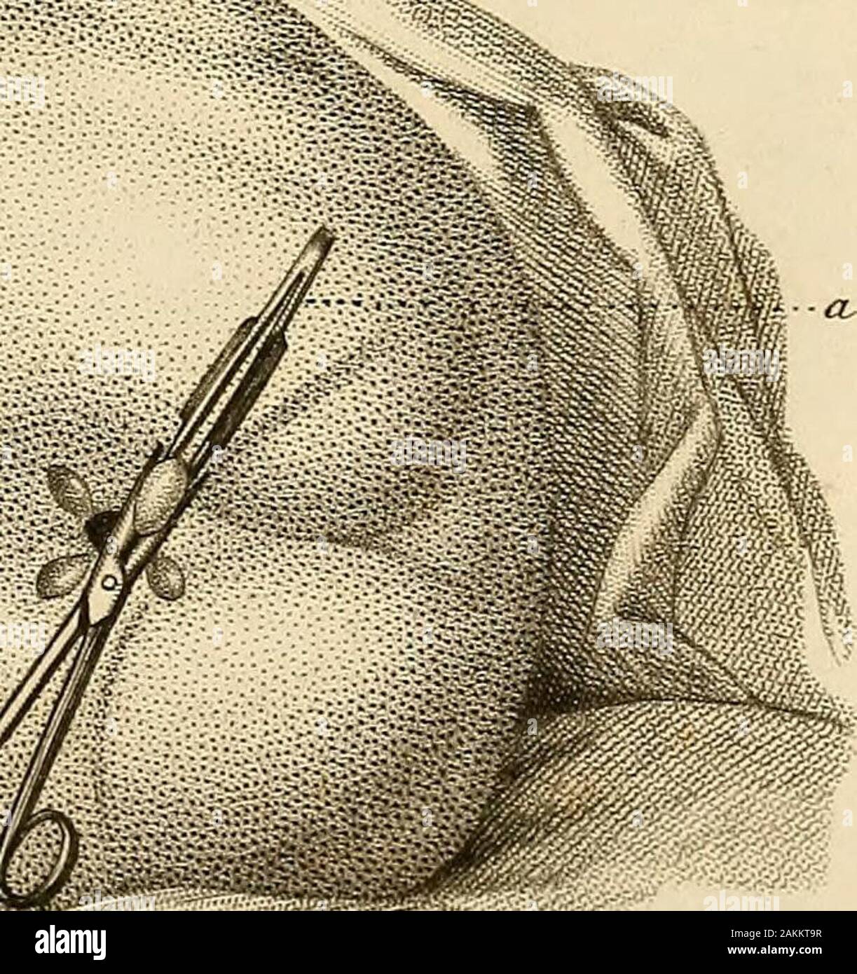 Précis iconographique de médecine opératoire et d'anatomie chirurgicale . Fier. 2 Si:::y.-y.-y.^. Fio- 3. & m Stock Photo