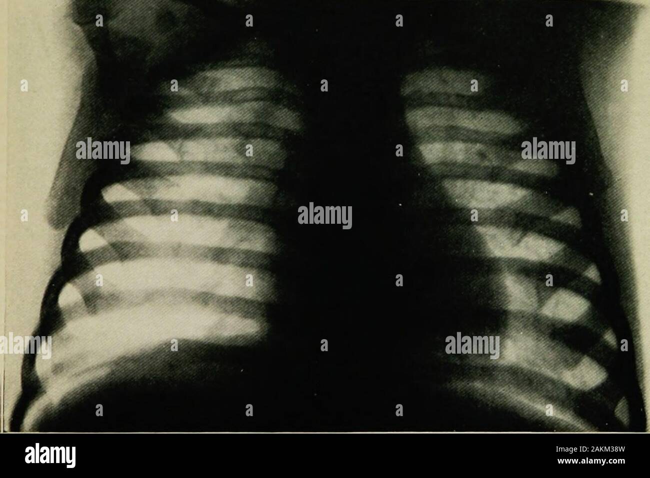 Scurvy Past And Present Fig Is Infant With Marked Scurvy Characteristic Posture And Swelling Of Right Thigh Fig 19 Same Infant As In Figure 17 Scorbutic Beading Of The Ribs Rosary This Devel Oped