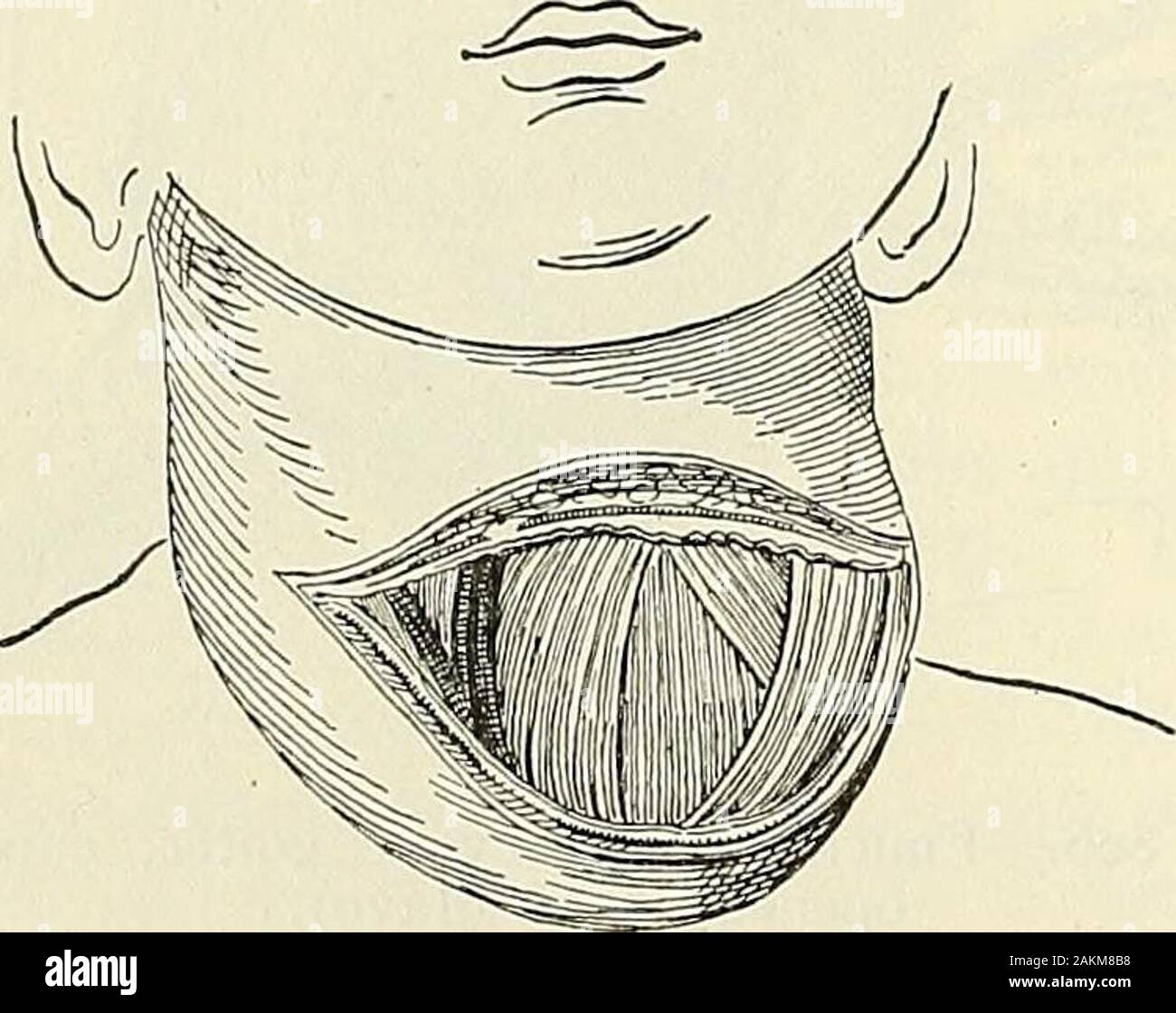 Modern surgery, general and operative . ssing glandulartissue being