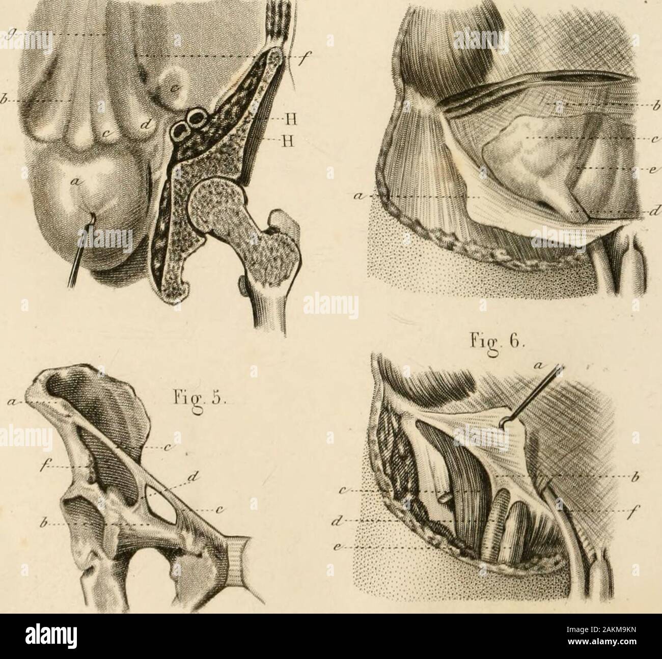 Précis iconographique de médecine opératoire et d'anatomie chirurgicale . Fip k Fig.3. B. — 263 —PI. 61. SUITE DE laNATOMIE CHIRURGICALE DE LA REGIONINGUINALE. Fig. 1. Une partie du muscle grand oblique et de son aponévrose a, est enlevée. Au-dessous se voit le muscle petit oblique b; lapo-névrose du grand oblique c, détacbée de sa partie supérieure a ,est renversée en bas sur la cuisse. Cette portion daponévrose sin-sère au ligament de Fallope ou arcade fémorale que nous étudierons plusbas, fig. 5 et 6. Fig. 2. Les muscles grand et petit obliques étant enlevés, on trouveplus profondément le Stock Photo