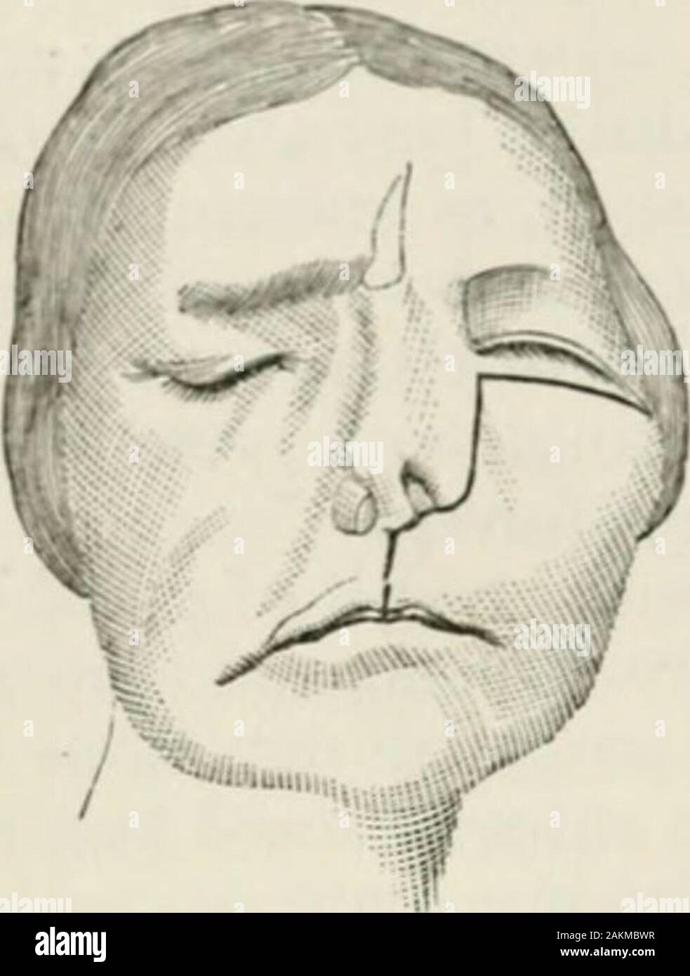Zygomatic surgery hires stock photography and images Alamy