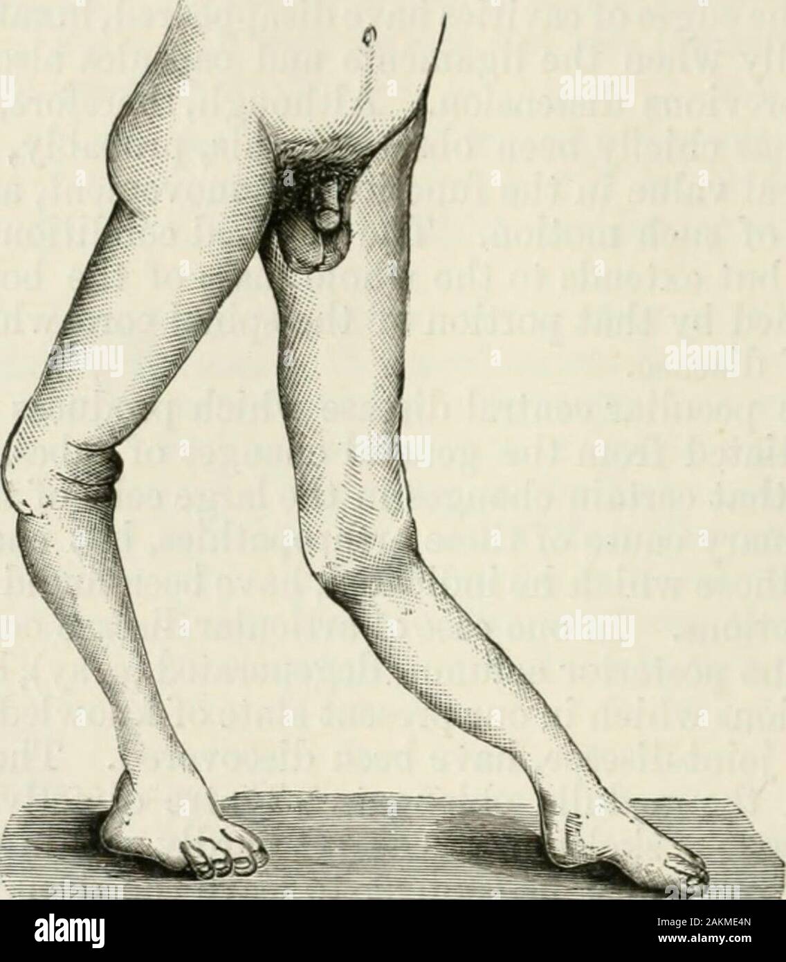 The international encyclopaedia of surgery; a systematic treatise on the theory and practice of surgery . od of ataxia, the patient * Buzzard, Pathological Transactions, vol. xxxi. p. 2G8. Qaz. des Hopitaux. Loc. cit. 428 DISEASES OF THE JOINTS, awakes with a limb greatly swollen, the enlargement being most marked ona level with the joint, where also it is most clearly aidematous or fluctuathig ;the ncighbtn-iiig parts are more brawny, and only pit on prolonged pressurewith the tinger. The tumefaction, although some exceptions to this rule occur, is absolutelywithout pain, redness, or other in Stock Photo
