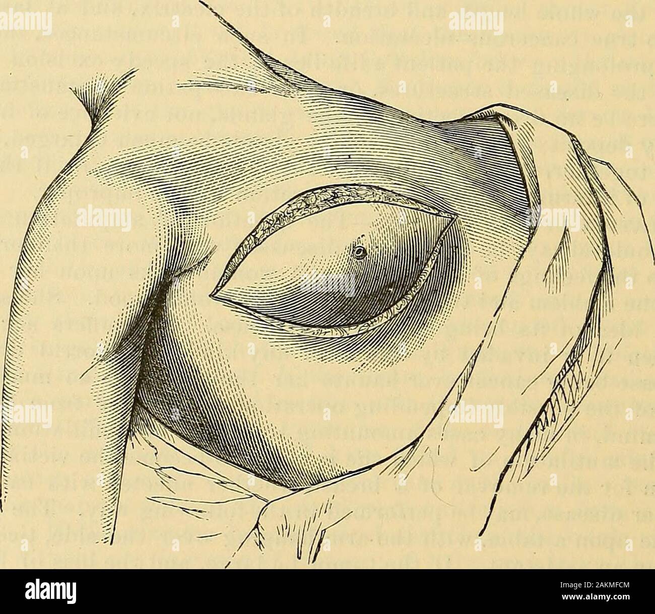 The science and art of surgery : being a treatise on surgical injuries,  diseases, and operations . ; 2. Always to remove the nipple;3. Alwaj^s to  remove widely all dimpled skin. The