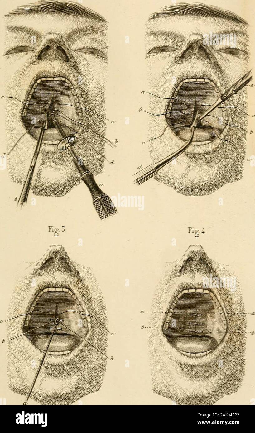 Précis iconographique de médecine opératoire et d'anatomie chirurgicale . rachosioplastie, a décrit un procédéqui nest quune modification du précédent. Les lambeaux qui résul-tent dune incision longitudinale pratiquée sur la tumeur sont ren-versés et fixés sur la muqueuse buccale à laide de quelques pointsde suture. Ce procédé est délicat et long dans son application. — 204 —PI. 50. STAPHYLORAPHIE. Fig. 1. Procédé de M. Roux. —La première et la seconde liga-ture, dd et ce, étant posées, lopérateur pose la troisième au milieu.La lèvre de la division est maintenue avec des pinces b, et laiguille Stock Photo