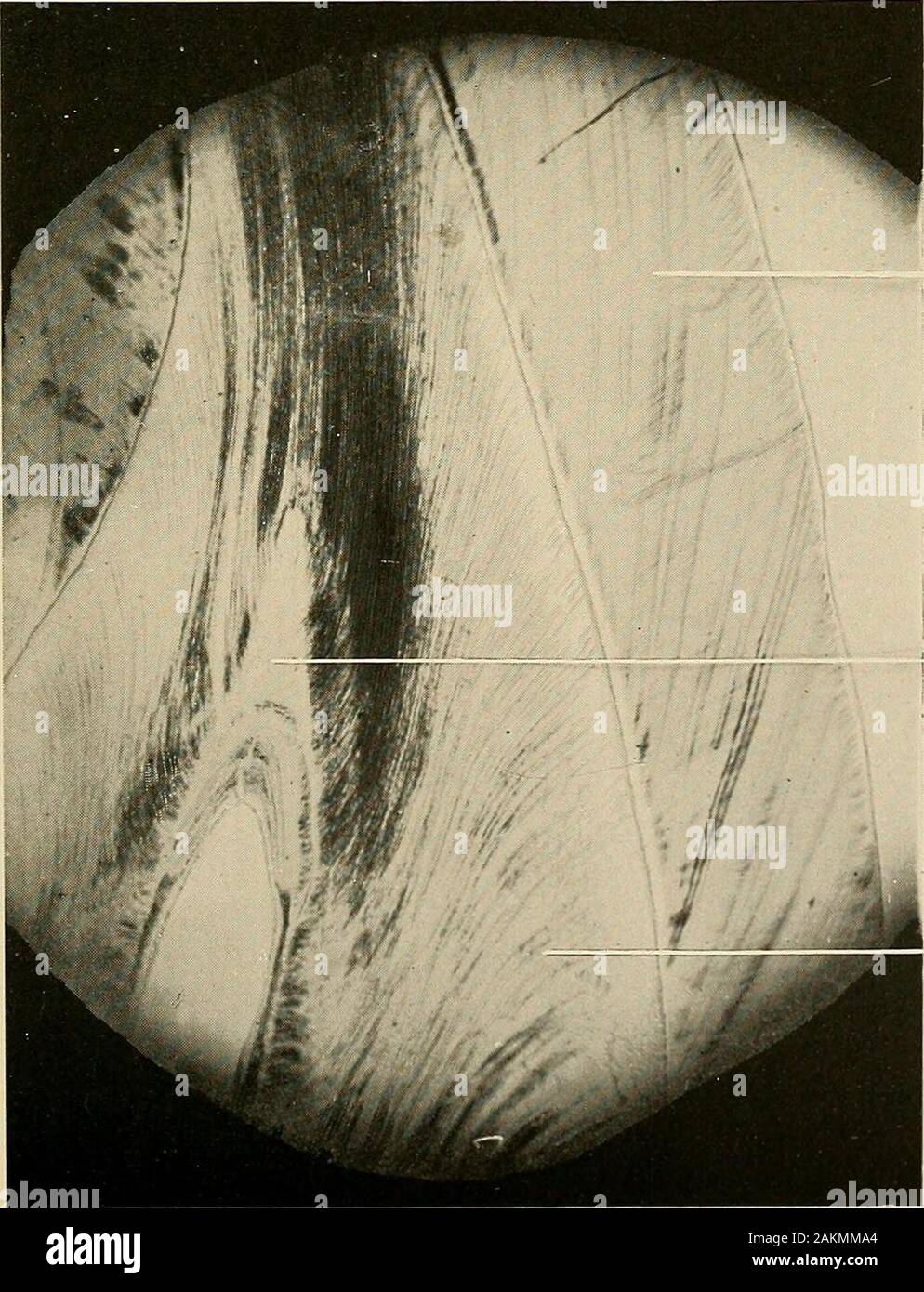 Principles and practice of operative dentistry . Knamel Secondary dentin 4 ? • ,» : ^ ^i^ ^ ijf,- ( .-j^^i )^m^Mjttt jM m^i^^ f- ^j^^lH^^^^^^^I Dentin Fig. 510.—Vertical section of human cuspid, showing formation of secondary dentin in the coronalportion of the pulp-chamber as a result of loss of tissue at the morsal edge. :&lt; 100.. Enamel Secondary dentin Fig. 511.—Vertical section of human central incisor, showing formation of secondary dentin in thecoronal portion of the pulp-chamber. X 102. EXPOSURE OF THE DENTAL PULP AND ITS TREATMENT. 481 fB Arsenous acid, Morphise sulph., aa gr. x to Stock Photo