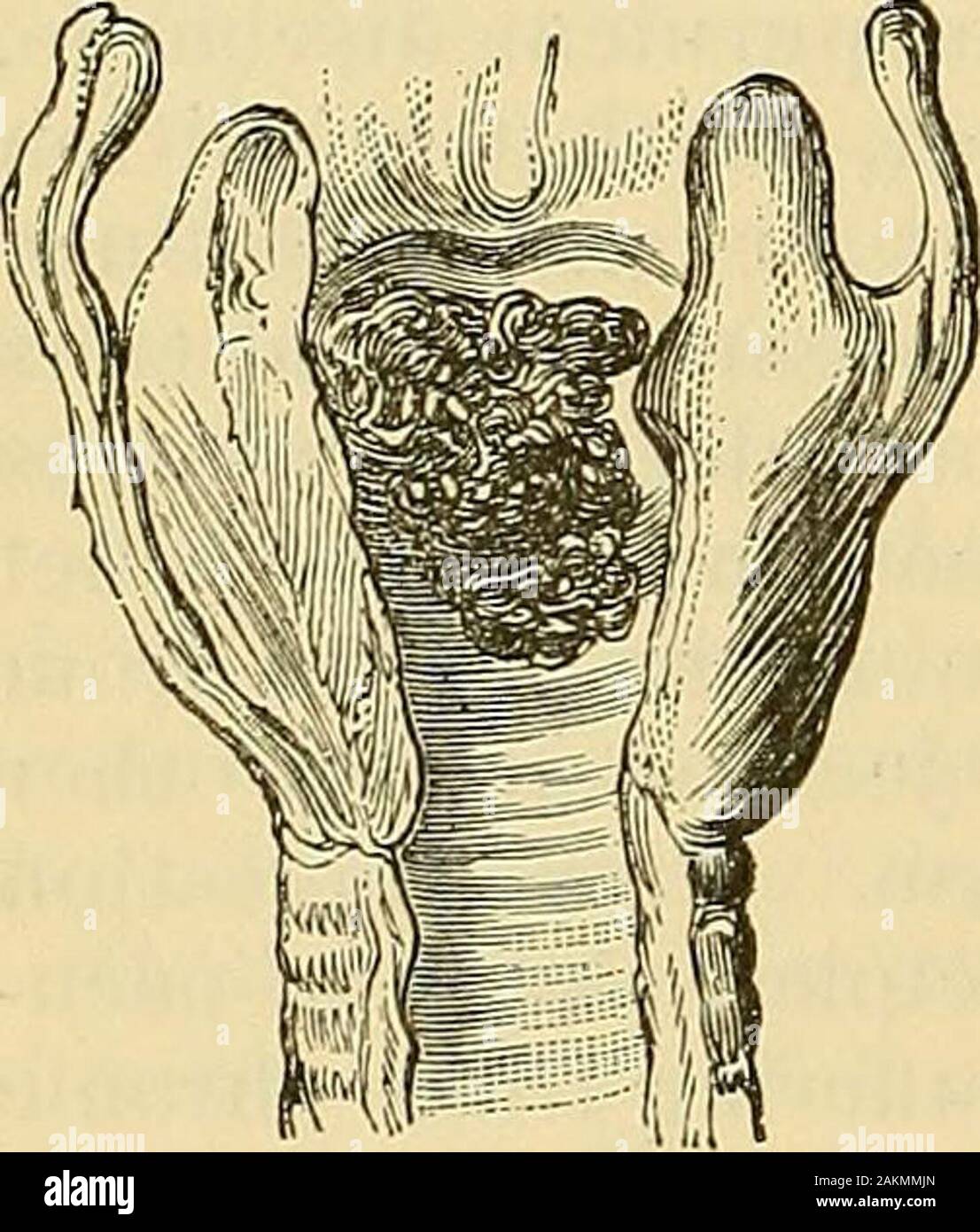 The science and art of surgery : being a treatise on surgical injuries, diseases, and operations . rouillou of Paris, and other conti-nental Surgeons. Gibb, in cases of this kind, sncceeded in passing aloop of silver wire round the bases of two such growths, lying justwithin the true vocal cords, and then detaching them by drawing thewires through a steel cannula, and so tightening the loop. This inge-nious operation has been performed several times with the aid of thelaryngoscope. Thyrotomy has been performed in some cases. Thisoperation consists in opening the trachea and introducing a trach Stock Photo