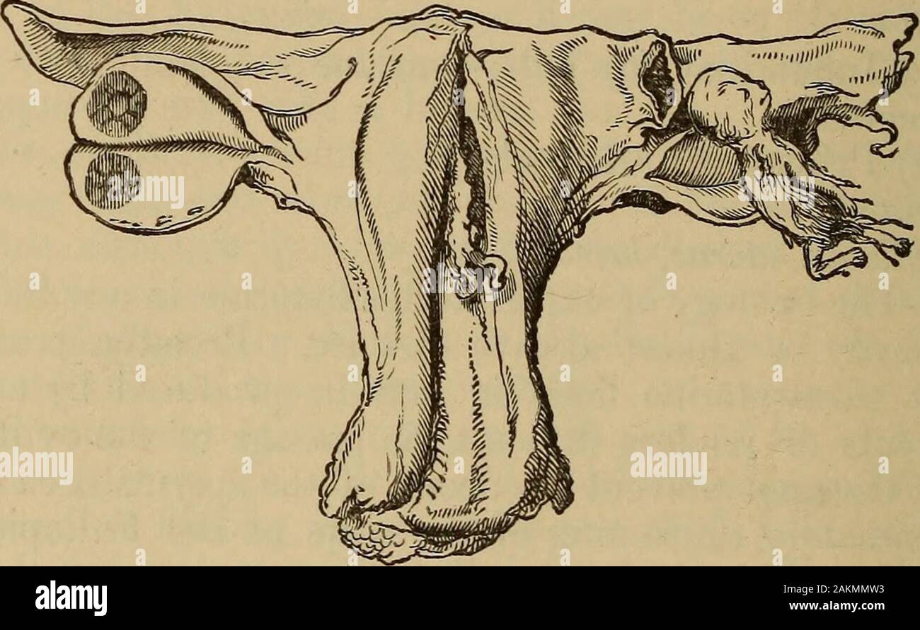 A treatise on the science and practice of midwifery . of abdominal pregnancyis probably less difficult to account for if we admit, with Coste, that theovule becomes impregnated on the surface of the ovary itself, for theremust be very many conditions which prevent the proper adaptation ofthe fimbriated extremity of the tube to the surface of the ovary, andfailing this the ovum must of necessity drop into the abdominal cavity.Kiwisch has pointed out that this is particularly apt to occur when theGraafian follicle develops on the posterior surface of the ovary; and,indeed, it is probable that it Stock Photo