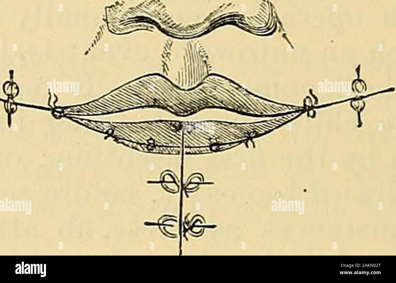 The science and art of surgery : being a treatise on surgical injuries, diseases, and operations . Fig. 612.—Lines of Incision in Cheiloplasty. Pig. 613.—Incisions and Sutures in Cheiloplasty. as to incise the included triangular piece ; the lower lip is then dissectedaway from the jaw, from the inside of the mouth, and a V-shaped pieceis taken out of its centre. By means of a hare-lip pin on each side, anda point of suture, the incisions in the angle of the mouth are broughtaccurately together; and in the same way the vertical one, in the centre,is united (Fig. 613). In this way the whole of Stock Photo