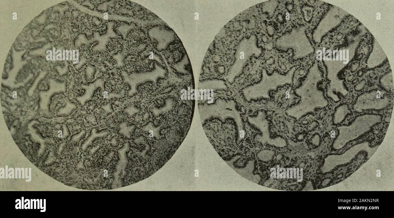 The Cleveland medical journal . Fig. IIT.Colloid Adenoma (dog) Fig. IV