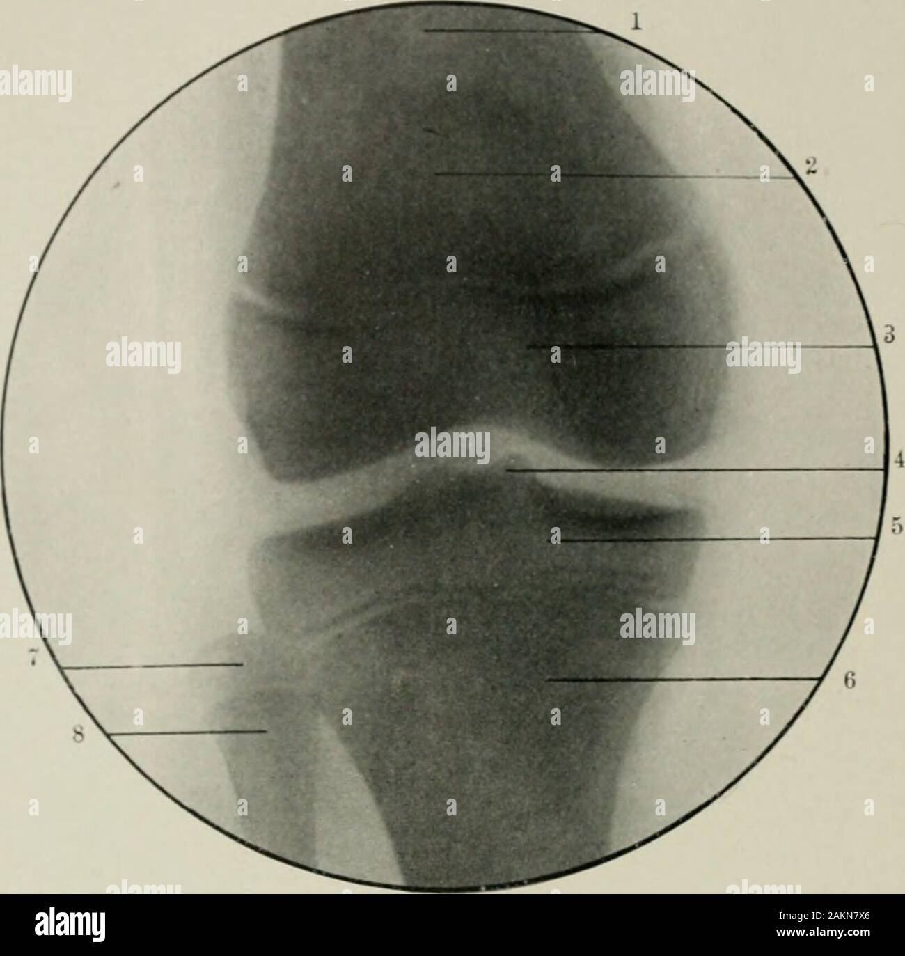 American practice of surgery : a complete system of the science and art of surgery . Fig. 168.—Lateral View of Knee Joint at Eleven Years. 1, Patella; 2, inner condyle; 3, epiphys-eal line at upper end of tibia; 4, epiphyseal line between the femur and the outer condyle; 5, outercondyle; 6, spine of tibia; 7, upper epiphysis of fibula. (Original.) somewhat like a tongue—a projection which afterward becomes the tubercleof the tibia. The antero-posterior view of the knee joint is shown in Fig. 169, which wasmade with the posterior surface of the joint next to the photographic plate.The distance Stock Photo