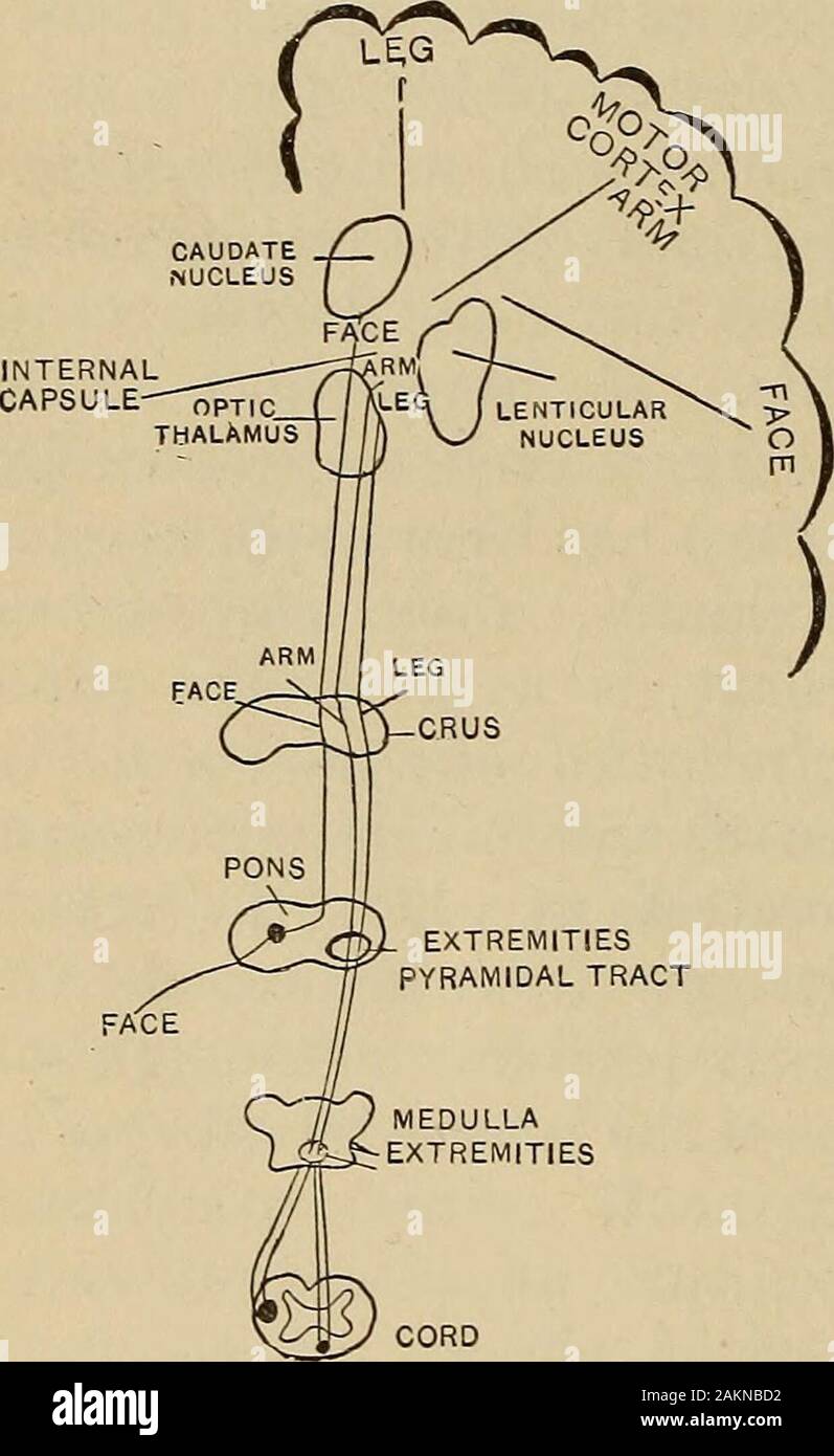 A treatise on the principles and practice of medicine . owish-white. The wallof the focus is irregular in the gray nucleiand regular in the white matter andthreads of bloodvessels run through it.Leukocytes laden with fat drops, hematoidin and disorganized tissue arefound. As the blood absorbs, the cavity becomes encapsulated by inflam-mation and contains a serous, milky fluid (the apoplectic cyst of Virchow).An apoplectic scar is much less common. Traumatic hemorrhage may occurinfrequently near the point of injury or conire coup on the opposite side;the late traumatic hemorrhage of Bollinger t Stock Photo