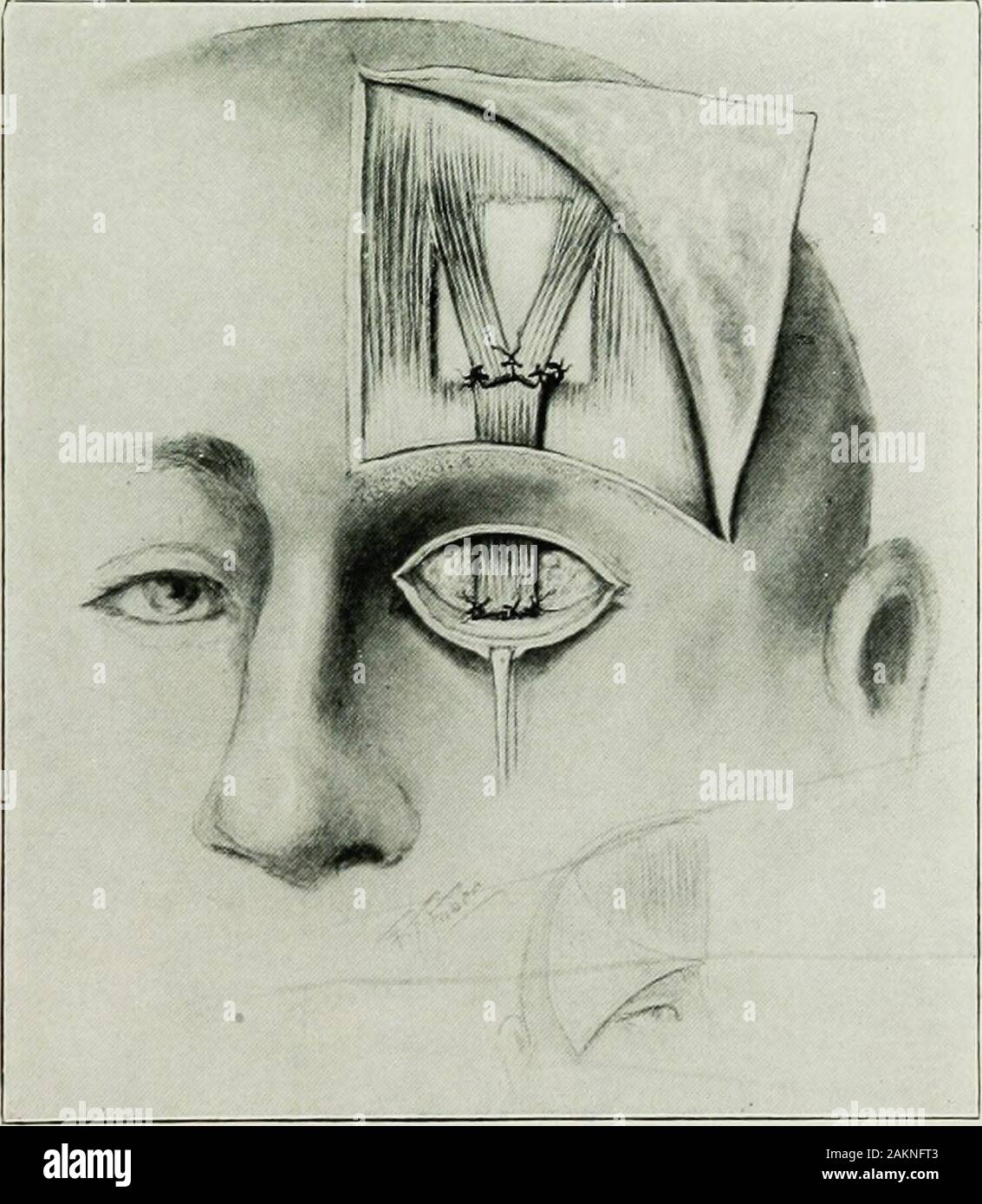 War surgery of the faceA treatise on plastic restoration after facial injury by John BRoberts ..Prepared at the suggestion of the subsection on plastic and oral surgery connected with the office of the surgeon generalIllustrated with 256 figures . whichrolls the eyeball upward. Perhaps a better method in the severe cases of ptosis is thatwhich shortens the suspensory ligament of the lid by means oftwo buried mattress sutures. By these stitches the tarso-orbitalfascia and the tendon of the elevator muscle are shortened bymaking horizontal gathers. These structures are uncovered bya horizontal c Stock Photo