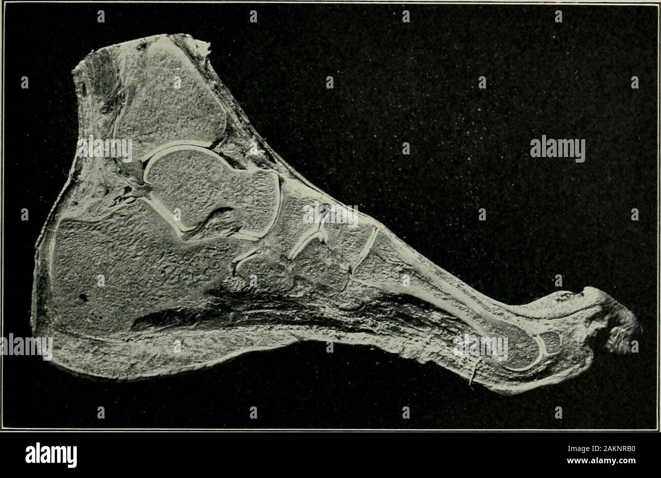 American practice of surgery : a complete system of the science and art of surgery . that position the widest part of the astragalus has passedfrom between the tibia and fibula, and the ligaments are more relaxed than inthe full plantar flexion, so that lateral movement to a limited extent is under TUBERCULOUS DISEASE OF BONES AND JOINTS. 713 such circumstances possible. When full dorsal flexion is brought about, theanterior and widest part of the superior articular surface of the astragaluspasses between the fibula and tibia and even to a sight extent separates thefibula from the tibia suffic Stock Photo