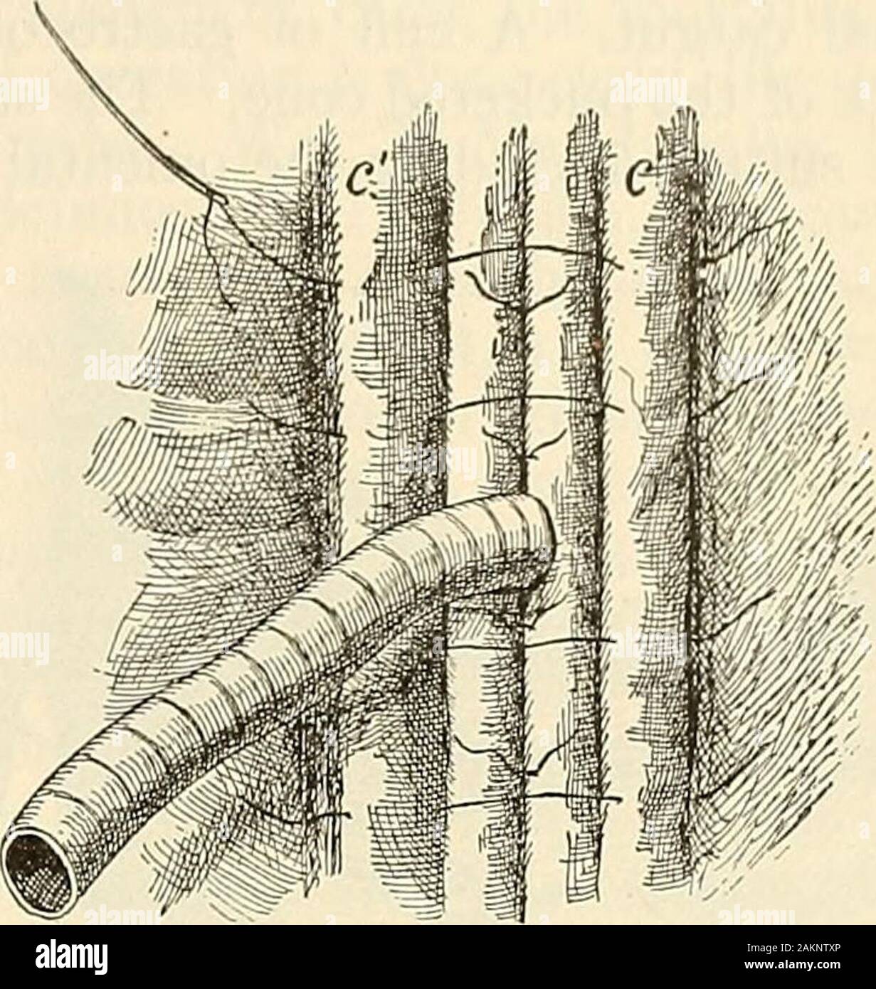 Gastrostomy hires stock photography and images Alamy