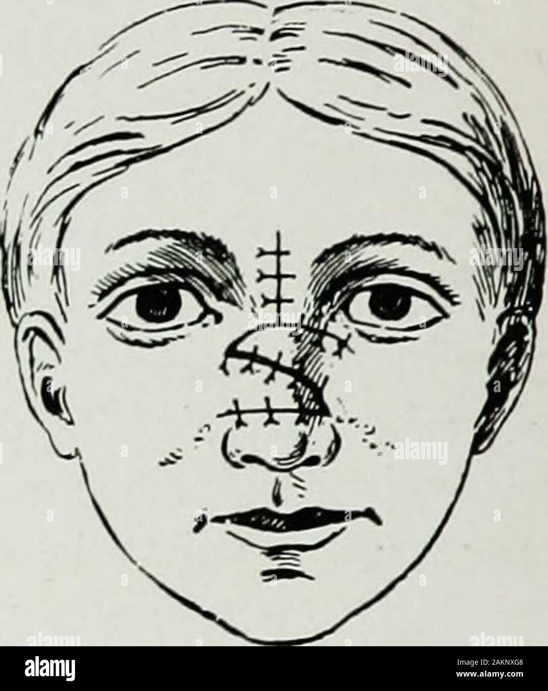 War surgery of the faceA treatise on plastic restoration after facial injury by John BRoberts ..Prepared at the suggestion of the subsection on plastic and oral surgery connected with the office of the surgeon generalIllustrated with 256 figures . Fie. 186.. Fig. 188. Figs. 185, 186, 187 and 188.— Robertss method of operating upon the sunkennose by superimposed Maps from cheek and nasofrontal regions. and that of the left flap is turned so as to reach across to a pointnear the inner canthus of the right eye. Sutures are employedto maintain the new relations of the frontonasal flaps, which have Stock Photo