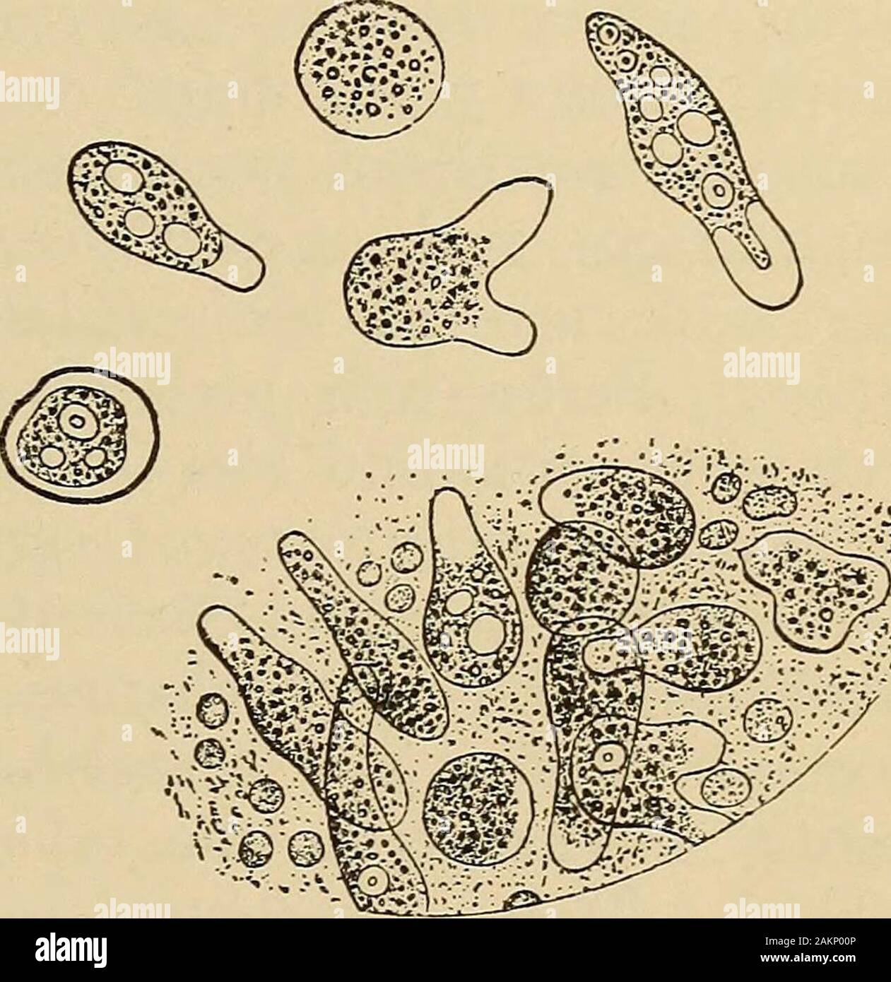 A treatise on the principles and practice of medicine . r from protrusion of pseudopodia, when theslide is slightly warmed; for diagnosis it must be motile. It is uni-cellular, and measures 10 to 50/x. Schaudinn distinguishes the innocuousEntameba coli from the pathogenic Entameba histolytica (Ameba dysen-teric), which is larger, has a highly refractile hyaline ectoplasm (moreclearly differentiated from the endoplasm), contains more vacuoles,has a sharper nucleus (5 to 7/x), and more frequent red-cell inclusions.Encysted amebse are resistant, dangerous forms, resembling the gametesof malaria ( Stock Photo