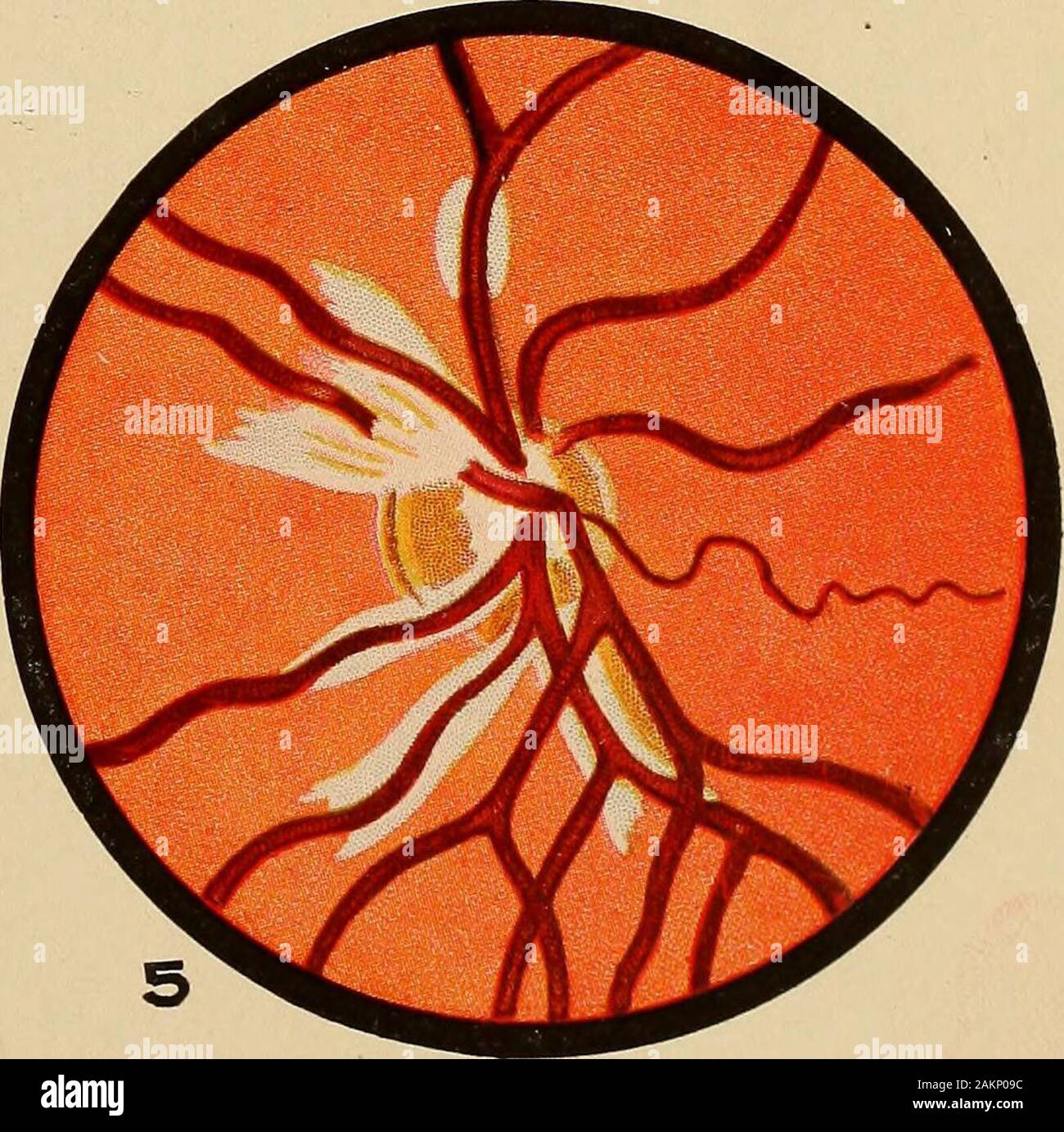 A treatise on the principles and practice of medicine . Retinal