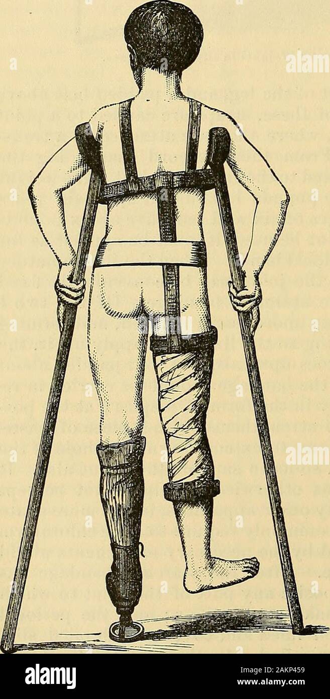 Immobility Splint Lessactive hi-res stock photography and images - Alamy