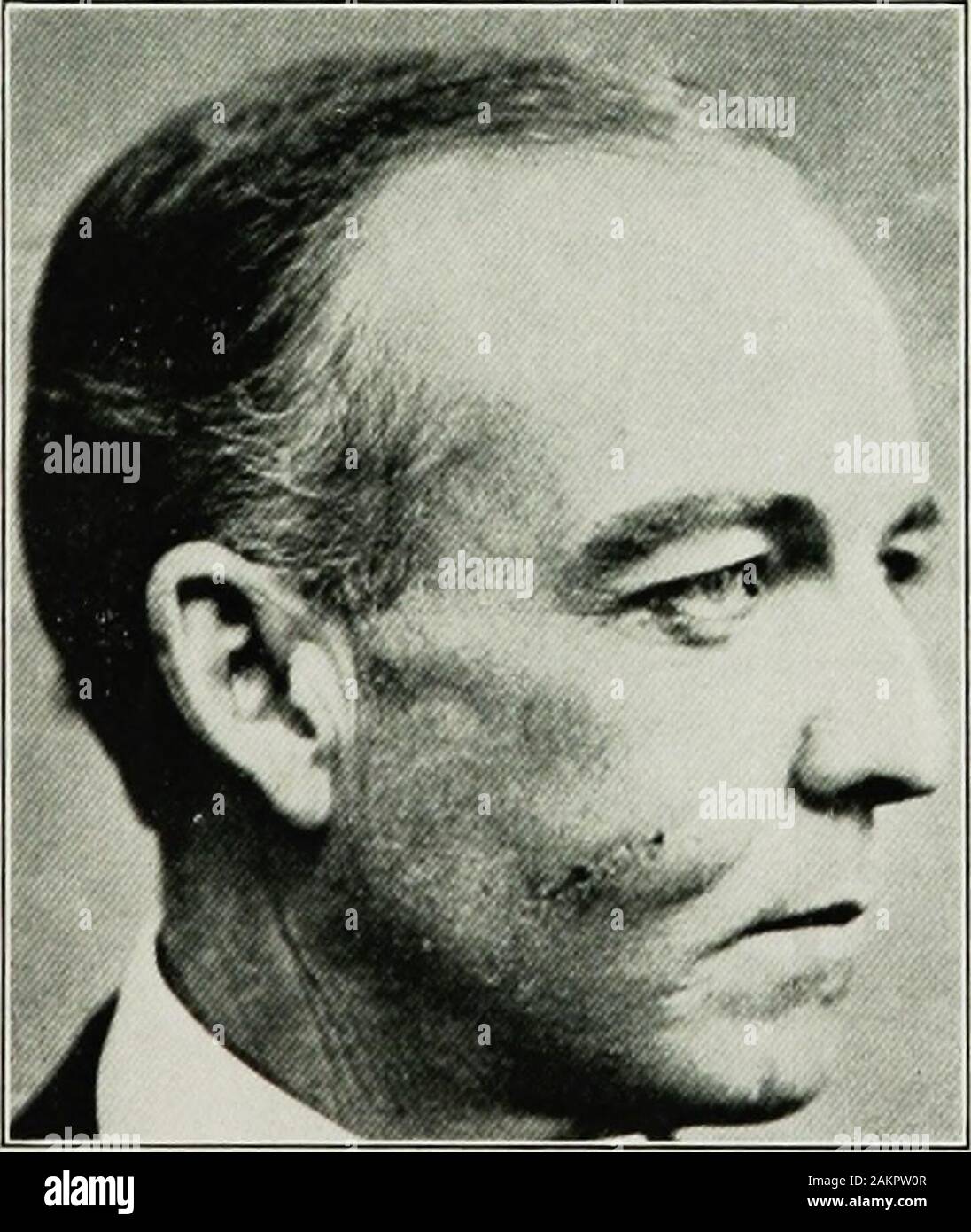 War surgery of the faceA treatise on plastic restoration after facial injury by John BRoberts ..Prepared at the suggestion of the subsection on plastic and oral surgery connected with the office of the surgeon generalIllustrated with 256 figures . Fig. 141.— Deep adherent scar of cheek from wound due to kick of a horse. (Authors patient.). Fin. 142.— Condition two weeks after graft of adipose tissue from abdom-inal wall was buried under scar. Photograph taken before graft had timeto shrink. (Authors patient.) 308 WAR SURGERY OF THE FACE. Contraction of scars following healing by granulation of Stock Photo