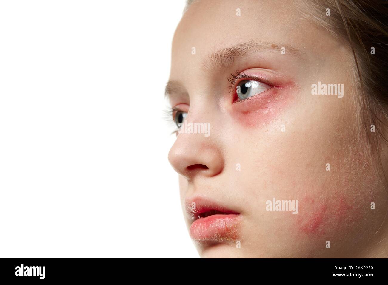 Allergic reaction, skin rash, close view portrait of a girl's face. Redness and inflammation of