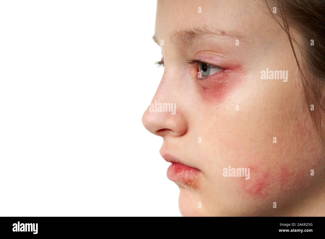 Allergic reaction, skin rash, close view portrait of a girl's face. Redness and inflammation of