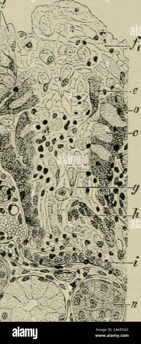 American practice of surgery : a complete system of the science and art of surgery . i^^wm^i^C^^^^^iis: Fig. 39.—Mucous Catarrh of a Bronchiis (Muellers fluid, aniline-brown), a, Ciliated epithelium: Oj,deeper cell layers; b, goblet cells; c, cells shov.ing marked mucous degeneration; c,, mucoid cells withmucoitl nuclei; d, desquamated mucoid cells; e, desquamated ciliated cells: /, layers of drops of mucus;/i, layer consisting of thready mucus and pus corpuscles; g, duct of mucous gland filled with mucus andcells; /(, desquamated epithelium of the excretory duct; i, intact epithelium of the d Stock Photo