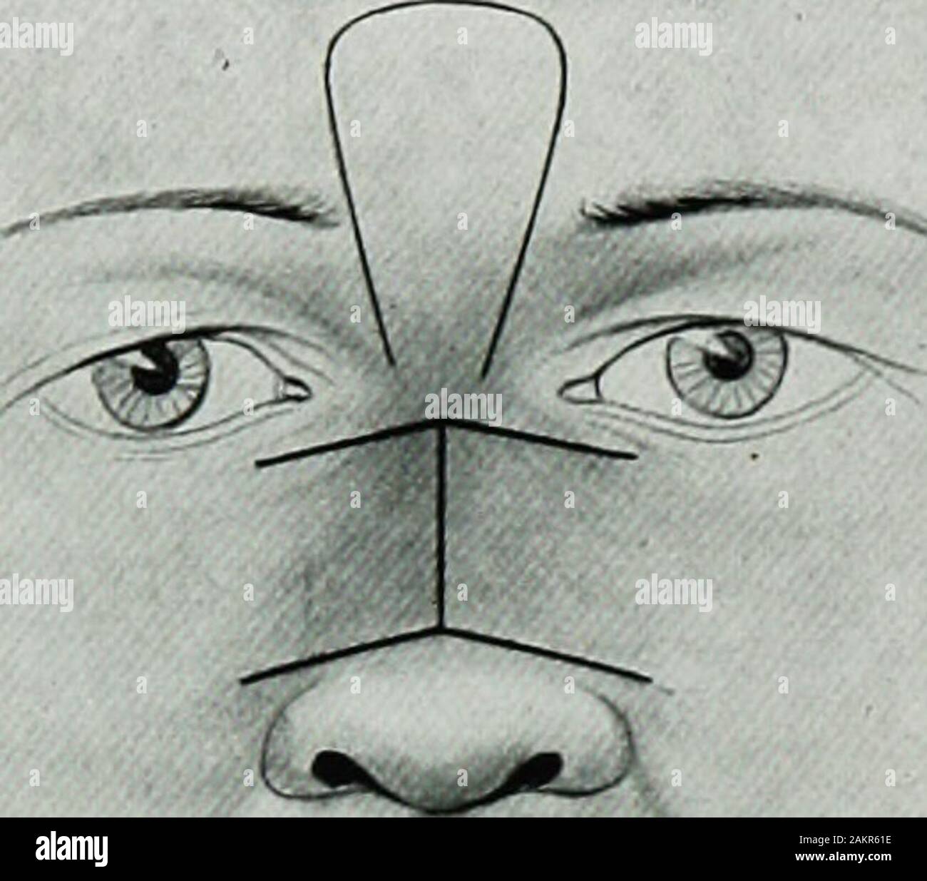 War surgery of the faceA treatise on plastic restoration after facial injury by John BRoberts ..Prepared at the suggestion of the subsection on plastic and oral surgery connected with the office of the surgeon generalIllustrated with 256 figures . Fig. 116.— Twisted flap. (Keens Surgery.) Incisions: In furrows, in shadows; Oblique to make perfect apposition; Scalpel for raising flap; midpoint scalpel or bistoury for incisions;Broad surfaces of contact when edges are to be united, as in harelip and cleft palate.Suturing: Wire, worm gut, thread, horsehair for apposition of edges and surfaces.Int Stock Photo