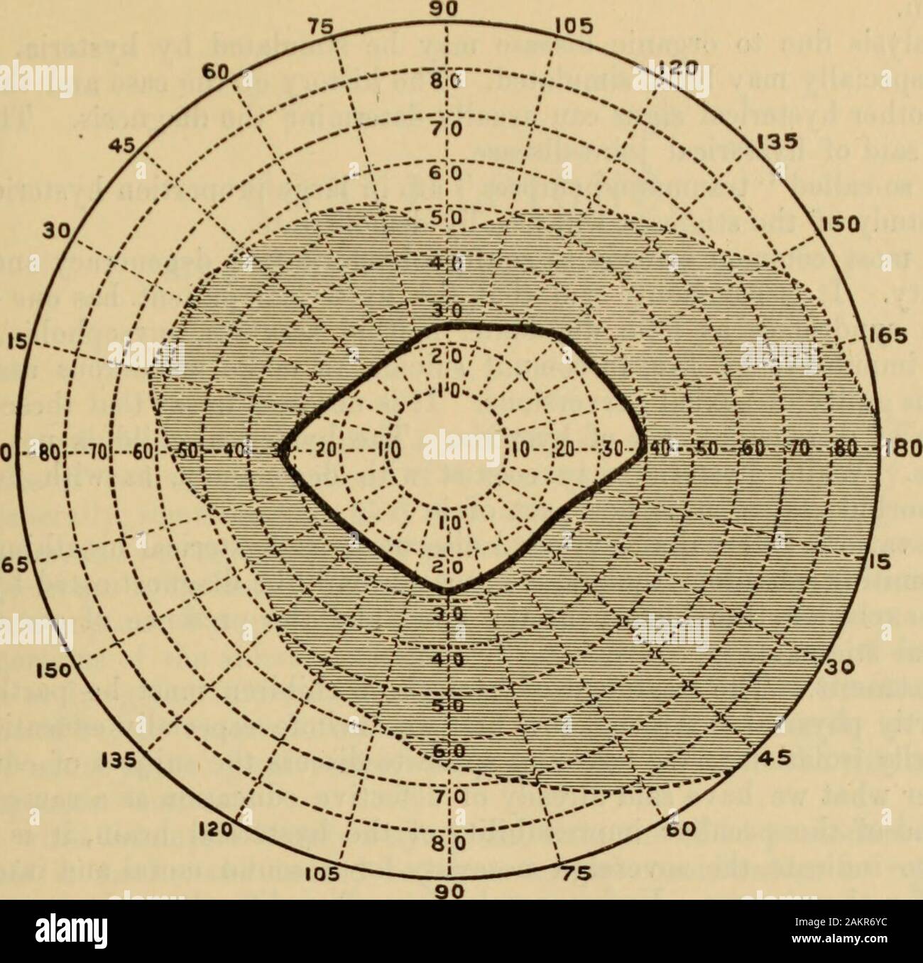 An American text-book of the diseases of children .. . ? a ill a ?tf Q. ^ h- S?8* HYSTERIA, 739 Fig, 5.. 165V Contraction of the Visual Fields in Hysteria. Field of O. D. (From authors case.) flushed, and a rapt expression appears. The breathing is hurried and the pulse rapid.The eyes converge in internal strabismus and the pupils dilate. The arms may be placedin any position, and remain fixed in true cataleptoid rigidity (see Fig. 1). The hystericalsymptoms are seemingly interrupted at times by the catalepsy. The tonic stage lasts fora long time. The clonic stage is of rather short duration, Stock Photo