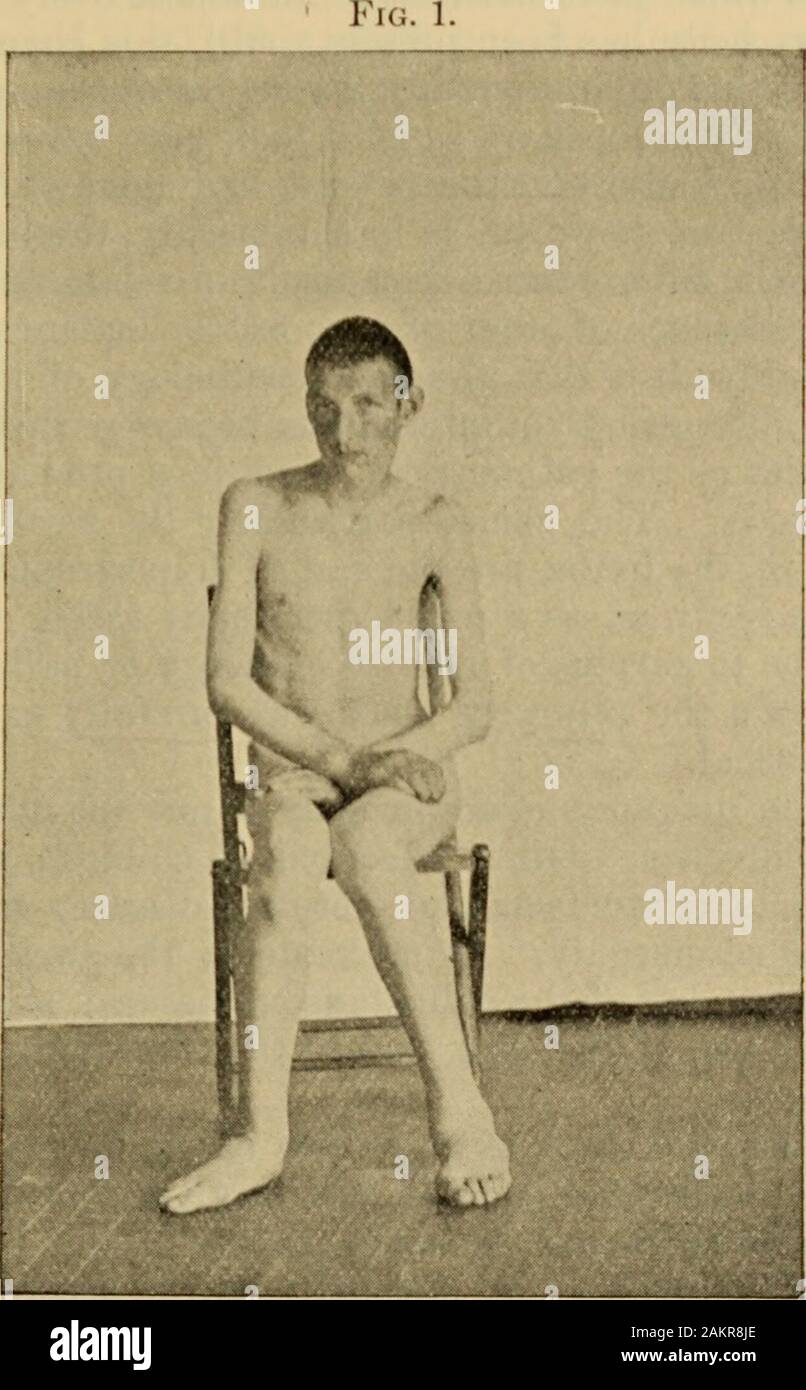 An American text-book of the diseases of children .. . nd feet are dusky and cold. When thehands are pendent, the dusky area reaches to at least two inches above the wrists,but when they are hejd above the head the entire limbs become to a less degreeof the same hue. He has a marked tendency to indolent ulceration, particularlyin the distal portions of the extremities. At the end of the index finger of theleft hand are the remains of a formation similar to one which appears from timeto time at the end of any of the fingers. The finger-tip swells, and in a littletime contains serum and sometim Stock Photo