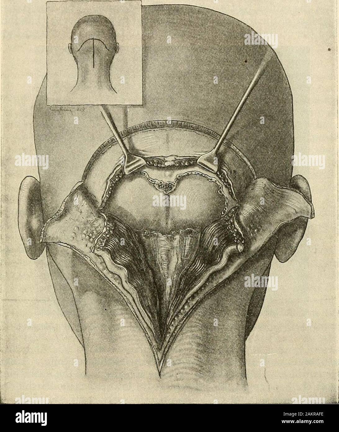 Modern surgery, general and operative . r suboccipital depression as done forsubtentorial tumors. The same exposure is obtained in order to remove acerebellar tumor. Drainage of the Cistema Magna (Hayness Operation).—An incision ismade in the middle line from the occipital protuberance to the posterior arch Methods of Reaching the Pituitary Body 833 of the atlas. The periosteum is strii:)ped from a portion of the occipital bone atand above the foramen magnum. The bone is trephined and is cut away intothe foramen magnum. The occipital sinus may not be present. If presentas a double sinus, incis Stock Photo
