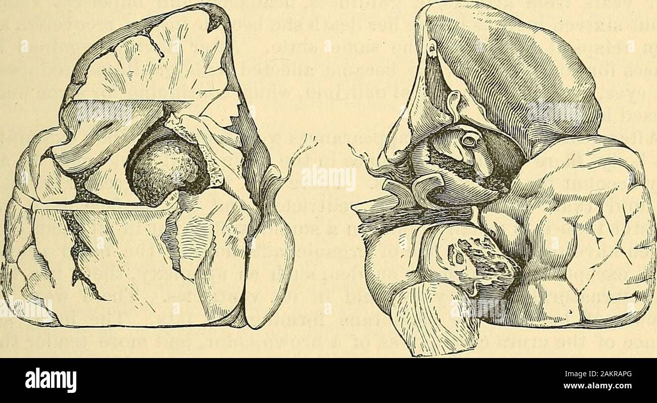 The science and art of surgery : being a treatise on surgical injuries, diseases, and operations . as large as a pigeons Ggg^ containing an irregularvery hard dry clot of blood, was found pressing on the pons Varolii.The sac had given way at one point, extravasation taking place into thesubstance of the pons, which was softened, and of a bluish color. 2. The most frequent mode in which death takes place in these casesis by the sttdden rupture of the sac and extravasation of blood into thecavity of the arachnoid and the meshes of the pia mater at the base ofthe brain, or into the lateral ventri Stock Photo