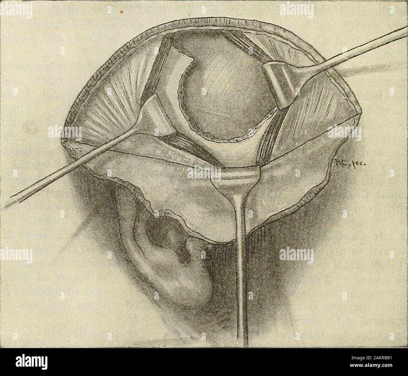 Modern surgery, general and operative . the Head not be done directly over a tumor, because the bulging tumor might becomethe seat of hemorrhage. It may, however, be done near the tumor (see page820). It is, of course, useless in relieving blindness, for blindness means atrophy,but it is often very valuable in preventing blindness. When choked disk existsoperation should be done early even if there is good vision. If in advancedcases any sight remains, it should be performed. Now and then there is an un-favorable result, for instance, the development of retinal hemorrhages or the lossof vision Stock Photo