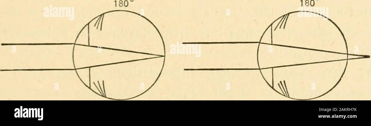 The refraction of the eye; including a complete treatise on opthalmometry; a clinical text-book for students and practitioners . Fi.. 66. — Shmviiic focuses of the chief meridians in simple myopic astigmatism of2 I), fm- distant vision and for near vision at the age of forty-five years. The 1 I). of presbyopia neutralizes 1 D. of the myopicastigmatism in the vertical meridian (leaving 1 D. of it uncor-rected), and at the same time renders the horizontal meridian(which is emmetropic) presbyopic, or in effect hypermetropic1 D. Thus the eye for reading purposes is mixed astigmatic,since it focuss Stock Photo