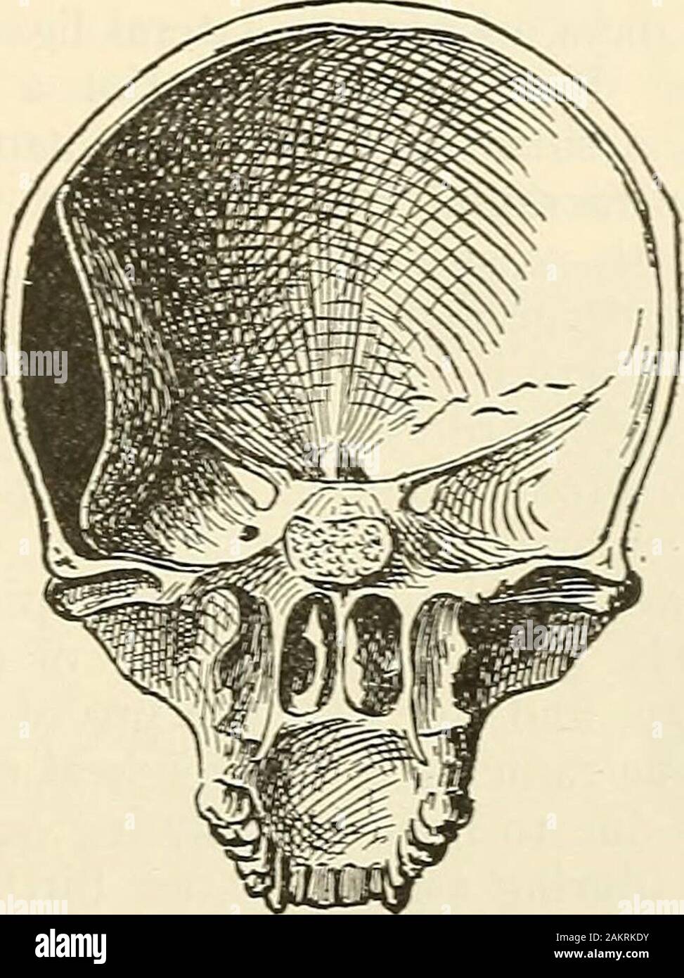 Meningeal hemorrhage hi-res stock photography and images - Alamy