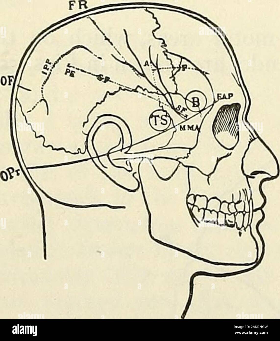 Modern surgery, general and operative . 11 n I . I . I I. Fig. 507.—Horsleys cyrtometer. ing the two. The mastoid antrum is opened through Macewens triangle toavoid injury to the lateral sinus. Barkers point, the proper spot to apply thetrephine for abscess of the temporosphenoidal lobe, is i^ inches above and i^inches behind the middle of the external auditory meatus. Fig. 508 shows clearly the main points of craniocerebral to-pography, obtained by methods approved bymany scientists. Kronleins method for localizing certainareas is the most generally serviceable (Figs.509, 510). A line, known Stock Photo