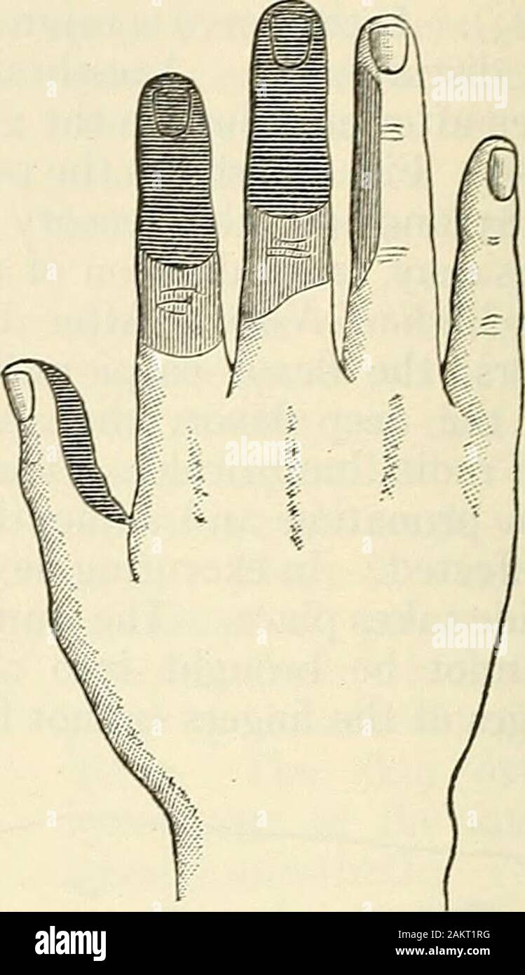 Modern surgery, general and operative . Fig. 486.—Section of median
