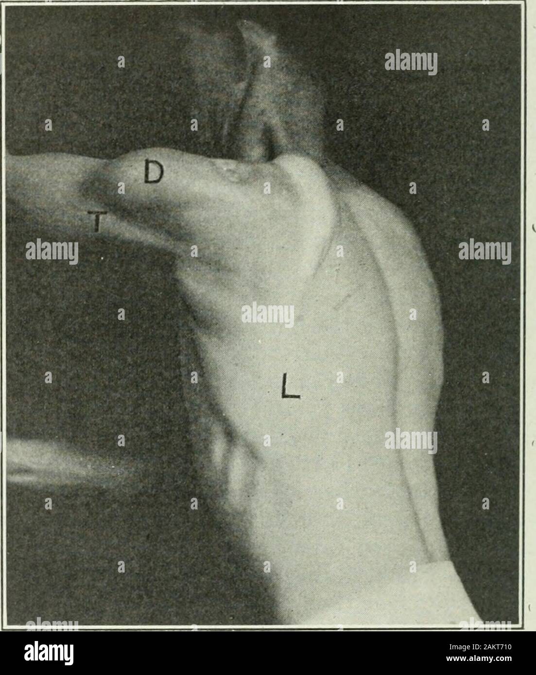 Arm Posturing Inward Applied anatomy and kinesiology; the mechanism of muscular movement ...