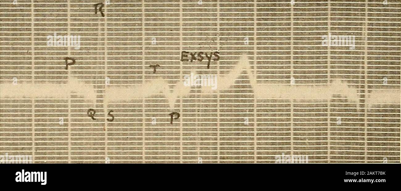 Clinical electrocardiography . rnating auricular premature contraction (Exsys.) arising at apoint in the auricular musculature distant from the sino-auricular node. The Pwave is negative (inverted). Electrocardiogram in Derivation II. becomes negative (inverted). Proof that the negative P wave isindicative of a change in the pace-maker is found in the work of 60 CLINICAL ELECTROCARDIOGRAPHY Lewis, von Hoesslin, Einthoven, Fahr and de Waart, Wilson, andCarter and Wedd. Figure 25 illustrates this type of prematureauricular contraction. White and Stevens have called attention to the fact that att Stock Photo