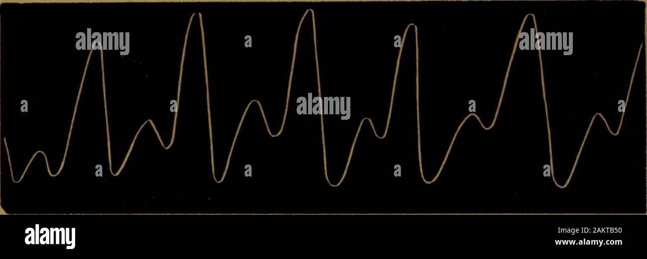 The sphygmograph and the physiology of the circulation : a monograph read before the Medical Society of New Jersey, upon investigations made preparatory to a larger work on the practical value of the sphygmograph . hese, thin rubber valveshave been found to work admirably. The auriculo ventricular valve is of more easy construction,being simply a drop valve, and in this heart was made ofleather. 3d. The large Sphygmograph, for recording the workingsof this artificial organ, is so arranged that any of the tubesmay be introduced behind the tracer, near its attached ex-tremity. The tracer is two Stock Photo