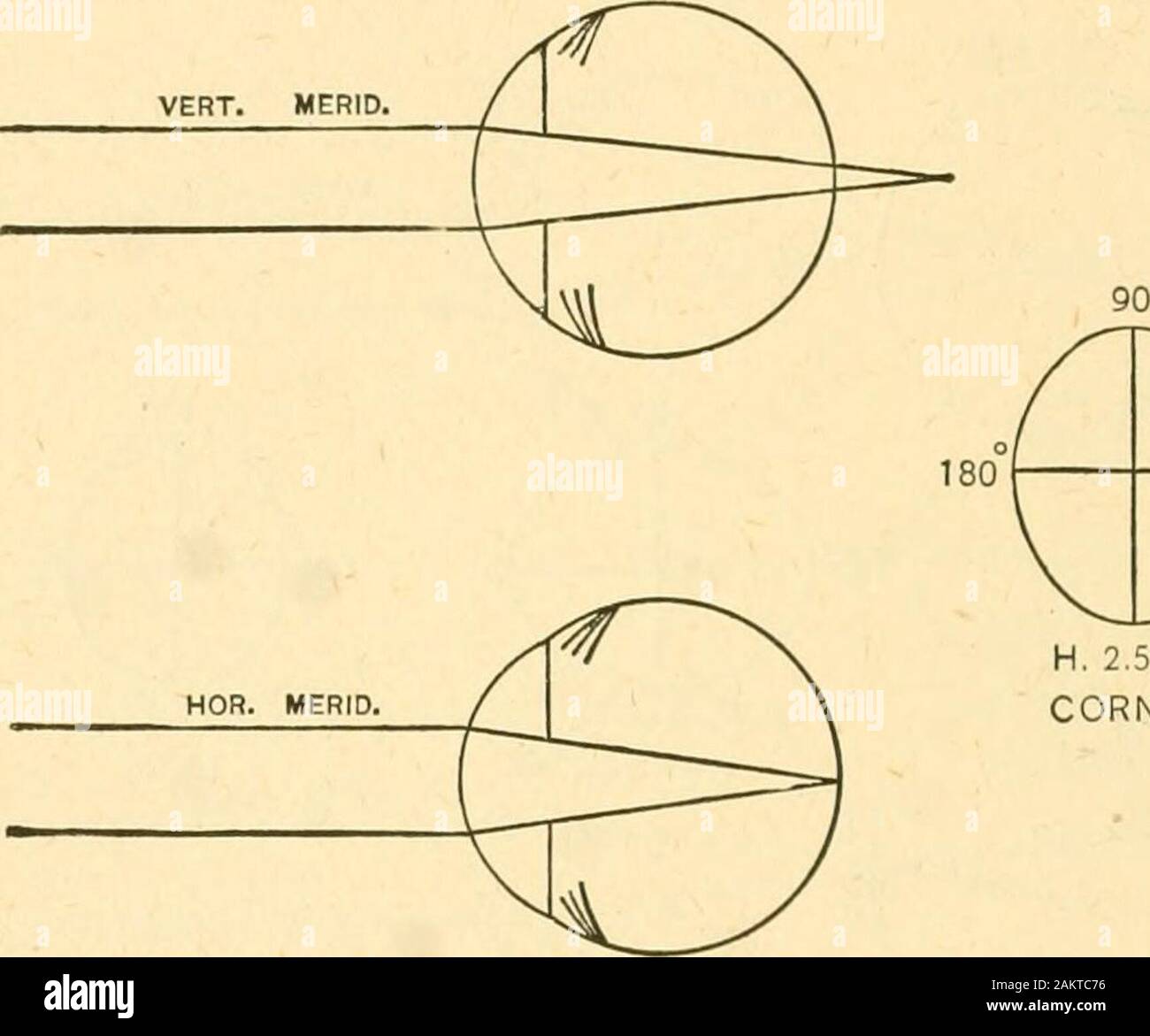 The refraction of the eye; including a complete treatise on opthalmometry; a clinical text-book for students and practitioners . ., butmay be more or less. Sometimes it is only .25 D., or may beabsent. Again, it may amount to .75 D., or 1 D., and excep-tionally to even larger amounts. As a rule, however, it amountsI), or .75 D., and in astigmatism with the rule, it beingof an opposite kind to the corneal astigmatism, it neutralizesto that extent the corneal astigmatism. And that is why wededuct such amount from the reading of the instrument whenthe astigmatism is with the rule. 2. In astigmati Stock Photo