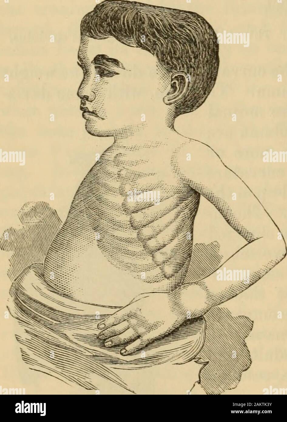 An American text-book of the diseases of children .. . e rendering it more easilyacted on by the muscles. The changein the upper jaw-bone he attributeslargely to lateral pressure of the zygo-matic arches. Changes in the Ribs.—The ribs areeasily affected in rachitis. The swell-ing of their anterior ends, where theyunite with the costal cartilages, pro-ducing the rachitic rosary, has beenalready alluded to as one of the firstand most conspicuous signs of rachitis. The costochondral articulations areenlarged in all directions, appearing as nodules under the skin. If at anautopsy an opportunity of Stock Photo