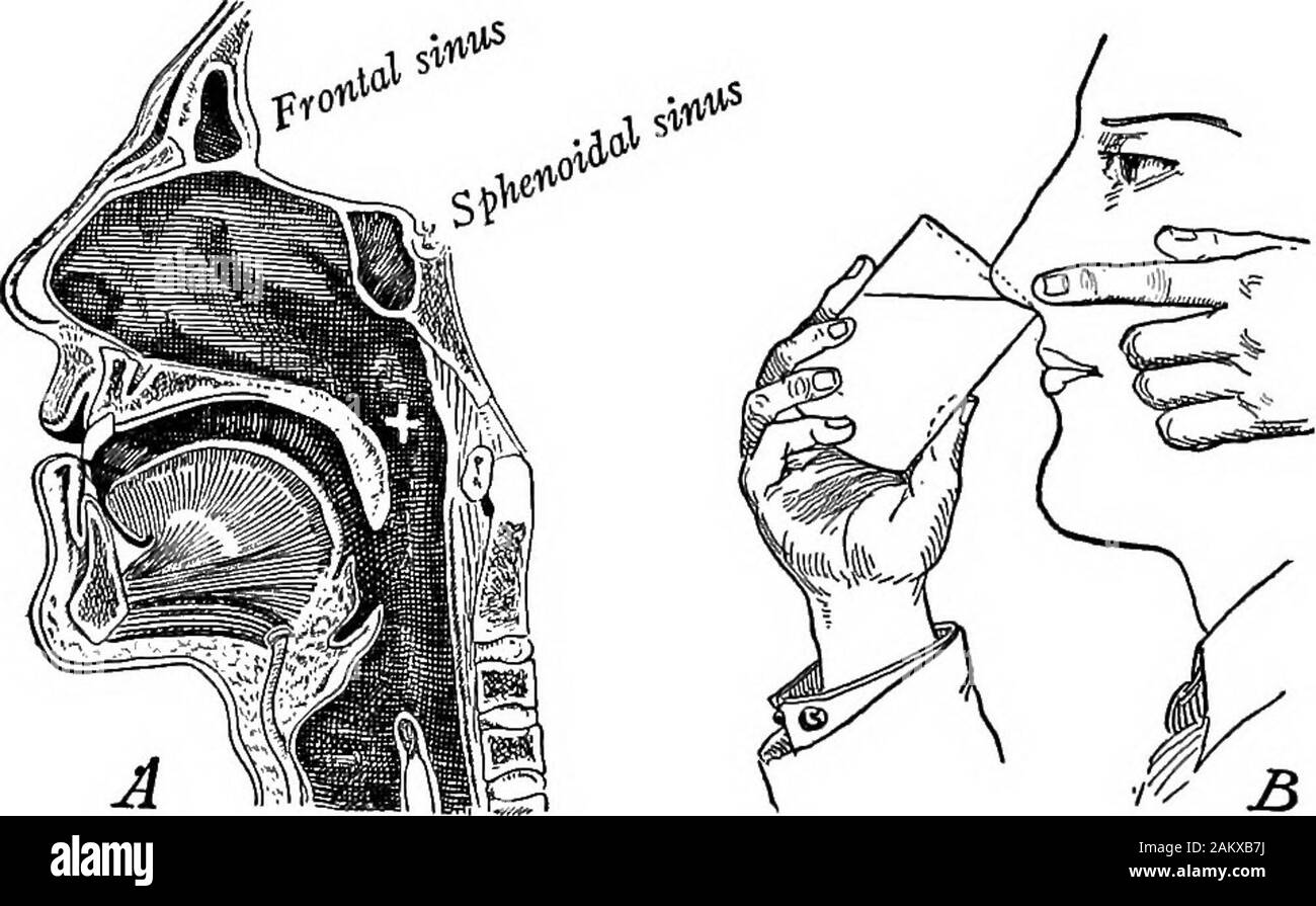 The principles of health control . hem, called sinuses(Fig. 71), where they cause a serious condition, known assinus infection. And germs may pass from the upperpharynx, by way of the eustachian tubes, to the middleear to cause the dreaded rising in the head, or ear abscess.The troubles to other parts that may arise from germcolonies in the nose and throat suggest the importance ofridding ourselves of any that may be present and of pre-venting future occupation of these places by our enemies. Remedial Measures. — If the outer fortifications of acountry have weakened from any cause, ordinary pr Stock Photo