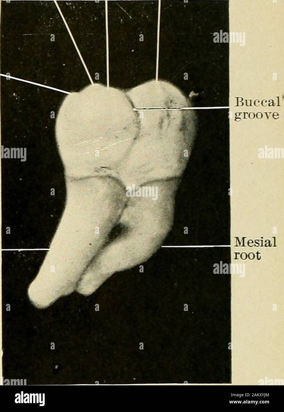 Principles and practice of operative dentistry . MedianDistolingwal ou
