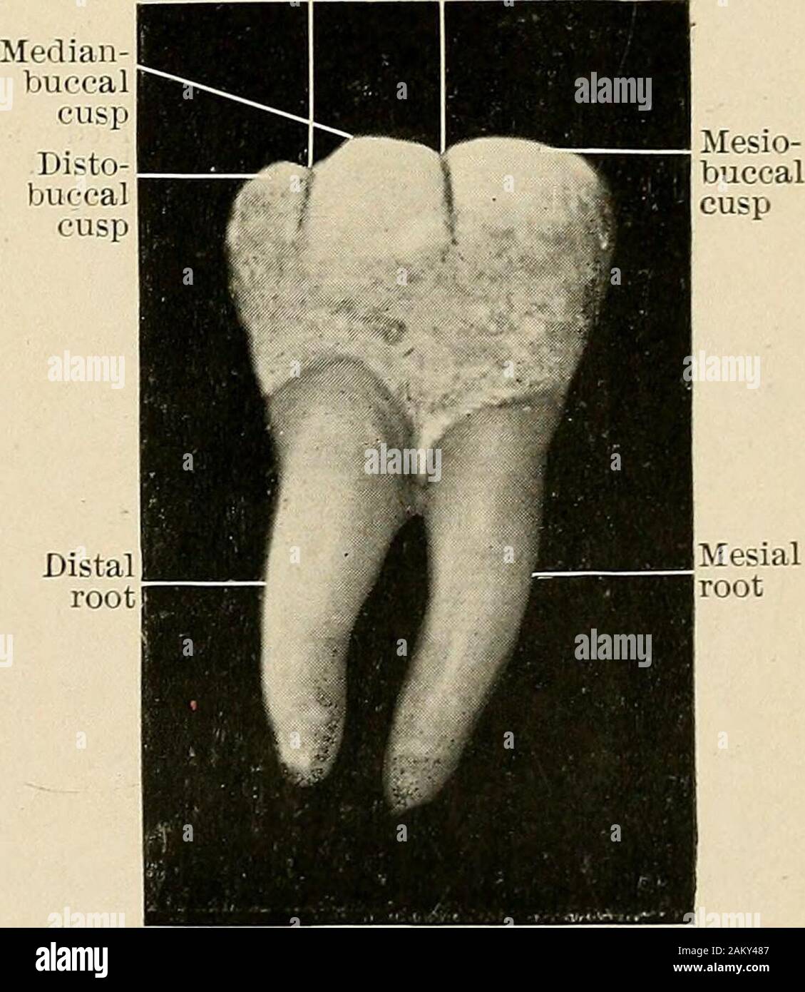 Principles and practice of operative dentistry . Mesiolingual cuspFig